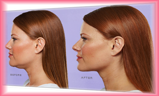 KYBELLA DR.B'SPA | PARMA, OHIO KYBELLA DR.B'SPA | PARMA, OHIO