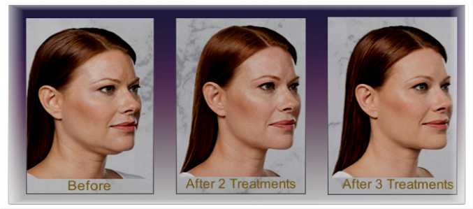 KYBELLA DR.B'SPA | PARMA, OHIO KYBELLA DR.B'SPA | PARMA, OHIO